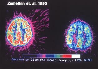 klinické skenovanie mozgu kvôli adhd