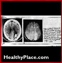 Neurológ John Friedberg, ako psychiatrické lieky a elektrošok poškodzujú mozog. Tvrdí, že všetci trpia určitým poškodením mozgu a stratou pamäti.